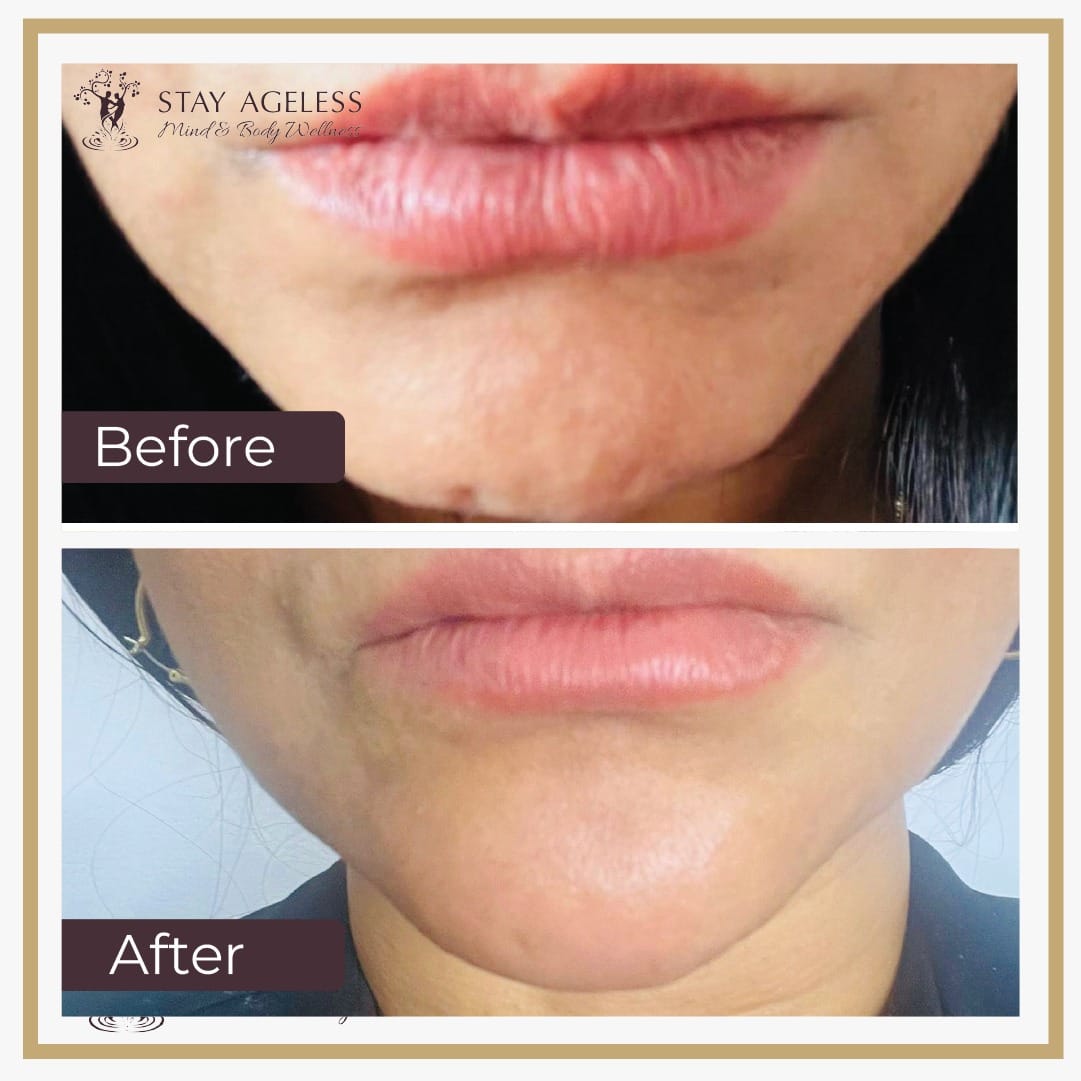 Lip Filler NYC 9 9b8a548a-e0e7-4500-a0e6-f8e3c5438496