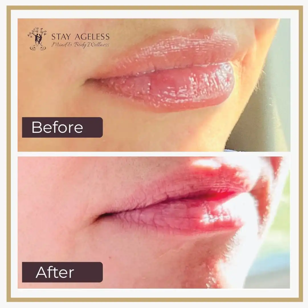 Lip Filler NYC 4 a473e793-1a90-4aef-83e7-27d673506527