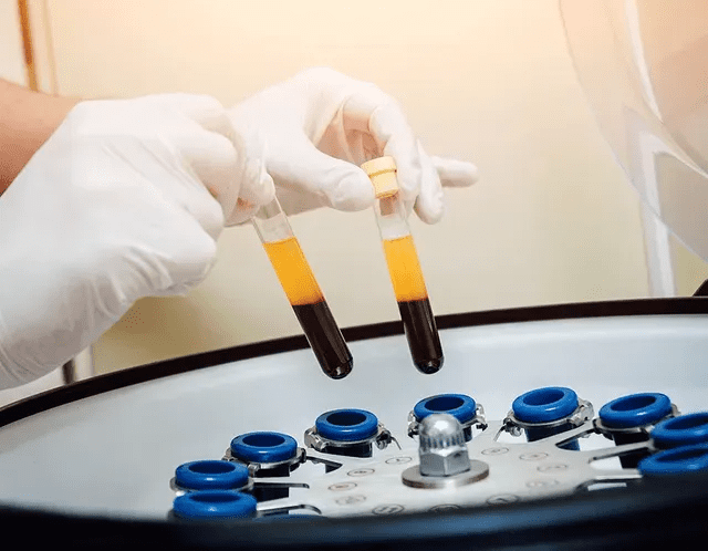 PRP 1 PRP facial at Stay Ageless Clinic, Plainview, NY