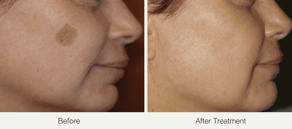 Before and after skin transformation at Stay Ageless Clinic NYC.