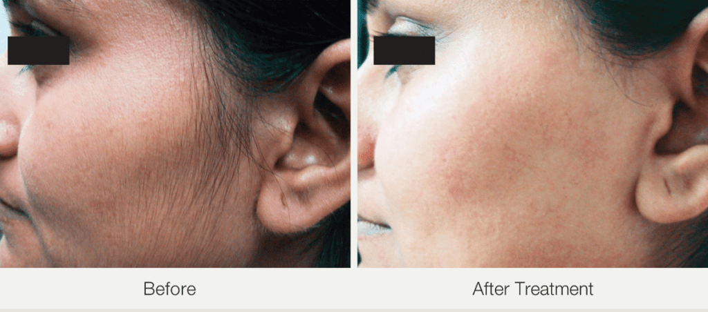 Before and after skin transformation at Stay Ageless Clinic NYC.