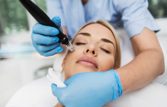 Microneedling