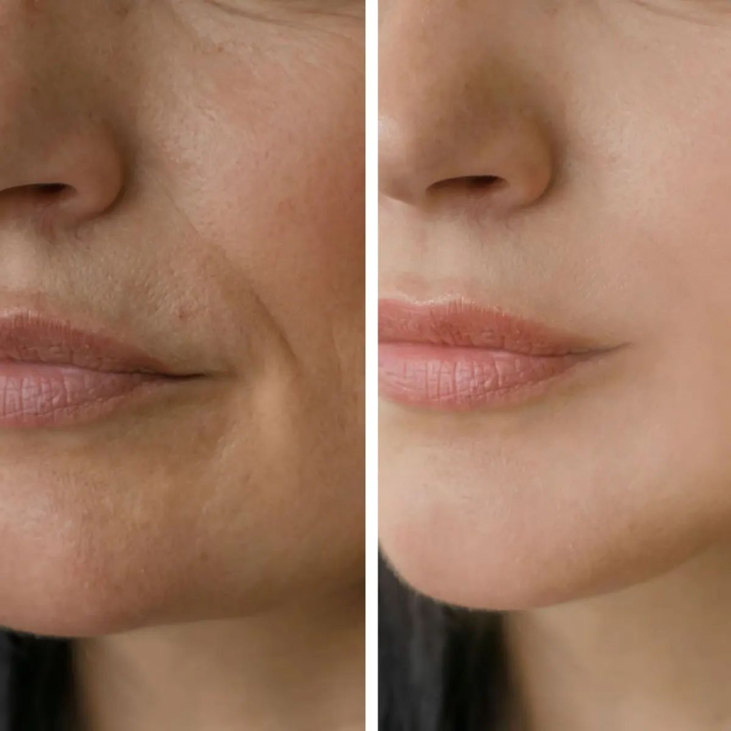 Full Face Rejuvenation