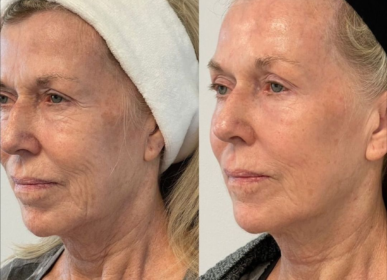 Full Face Rejuvination