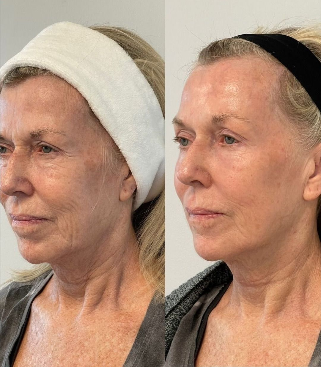 Full Face Rejuvination