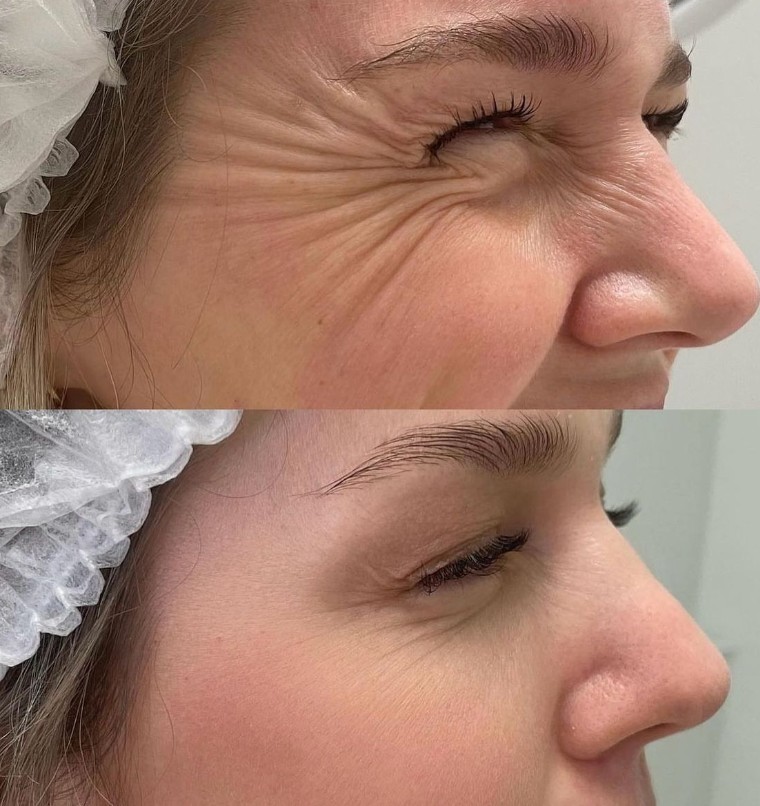Skin Tightening in Plainview NY 1