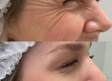 Skin Tightening in Plainview NY